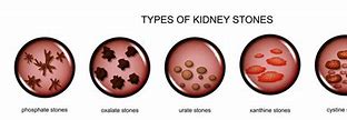 Image result for Small Kidney Stones