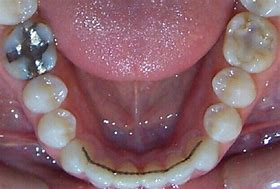 Image result for Braces Inside Teeth