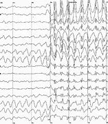 Image result for Spike-Wave Discharge EEG