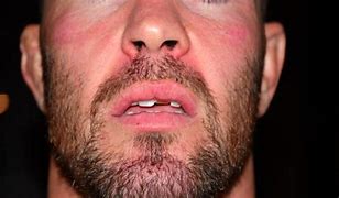 Image result for Colby Covington Teeth