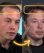 Image result for Elon Musk Hair Transplant