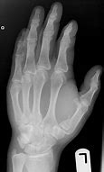 Image result for Broken Thumb