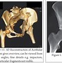 Image result for Bone Spurs On Hip