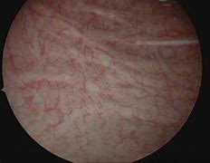 Image result for Pictures Inside Bladder Cystoscopy
