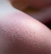 Image result for Blisters From SunBurn