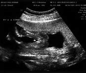 Image result for Anencephaly On Ultrasound