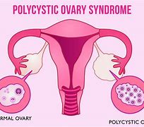 Image result for Polycystic Ovary