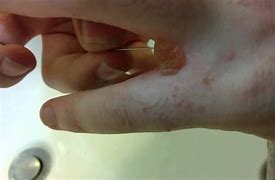 Image result for blisters pop infections