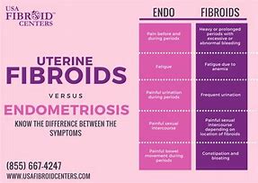 Image result for Fibroids Treatment