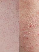Image result for Eczema vs Keratosis Pilaris