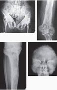 Image result for Vertebral Body Hemangioma CT