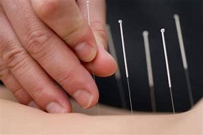 Image result for Acupuncture Ancient China