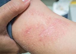 Image result for Contact Dermatitis Rashes