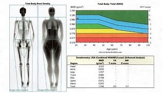 Image result for Dexa Scan Results Chart