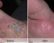 Image result for Molluscum On Feet