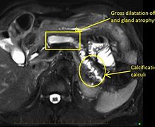 Image result for MRI MRCP Pancreas