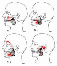 Masseter The Trigger Point Amp Referred Guide