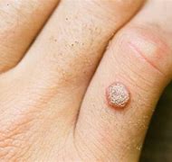 Image result for Warts On Skin Caused by HPV