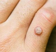 Image result for Genital Wart Treatment Cure