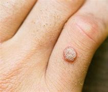 Image result for Wart Pictures On Body