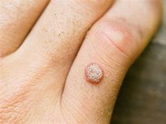 Image result for Genital Warts Treatment