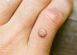 Image result for Gross Warts
