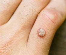 Image result for Seed Warts Treatment