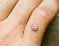 Image result for Common Warts