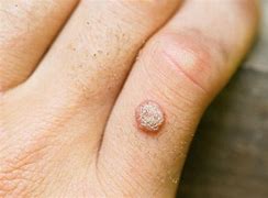 Image result for Common Warts On Hands