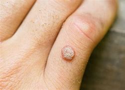 Image result for Flat Warts On Palms