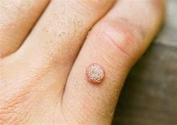 Image result for Different Kinds of Warts On Hands