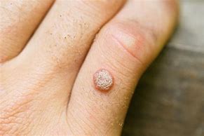 Image result for Wart On Elbow