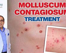 Image result for Molluscum Contagiosum Prescription Treatment