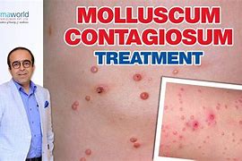 Image result for Molluscum Treatment Adults