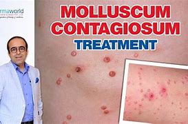 Image result for Molluscum Contagiosum Treatment in Pediatrics Medication