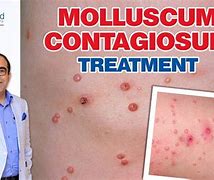 Image result for Molluscum Contagiosum Antibiotic Treatment