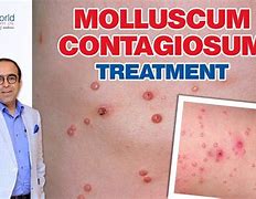 Image result for Molluscum Contagiosum Prescription Treatment