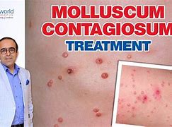 Image result for Molluscum Contagiosum Cantharidin Treatment