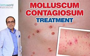 Image result for Pictures of Molluscum Healing