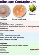 Image result for Stages of Molluscum