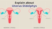Image result for Uterus Didelphys. Size: 176 x 100. Source: birlafertility.com