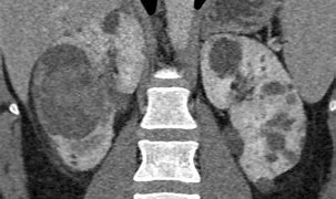Image result for Renal Cyst CT Scan