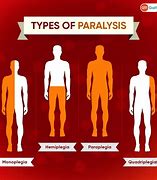 Image result for Types of Paralysis Stroke