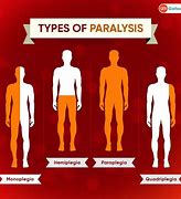 Image result for Different Stroke Paralysis