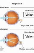 Image result for Astigmatism Rays of Light