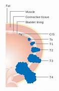 Image result for Bladder Carcinoma