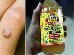 Image result for Apple Cider Vinegar Genital Warts