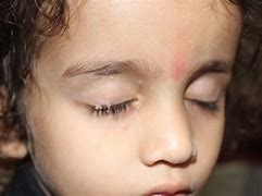 Image result for Molluscum Removal On Eye