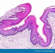 Image result for Cutaneous Papilloma