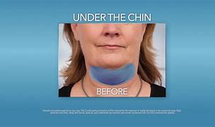Image result for Fat Freeze Double Chin